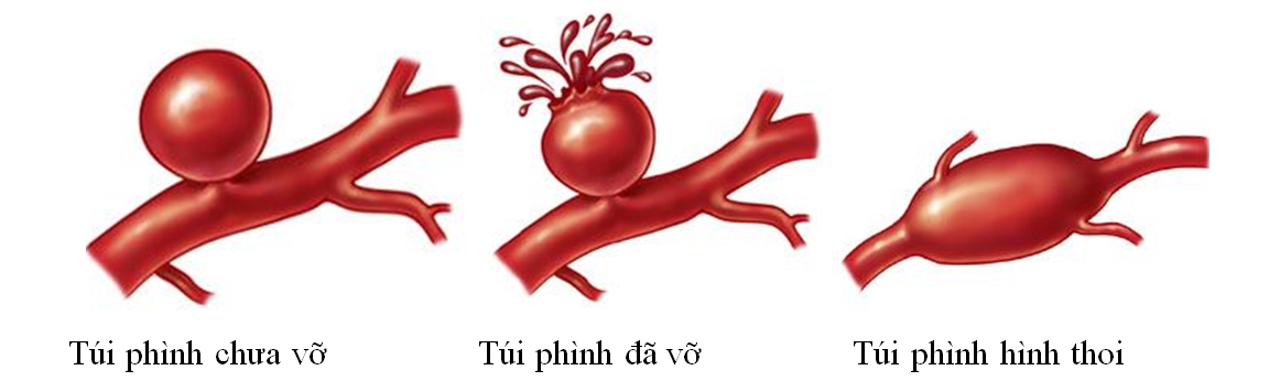 Mô tả túi phình động mạch não