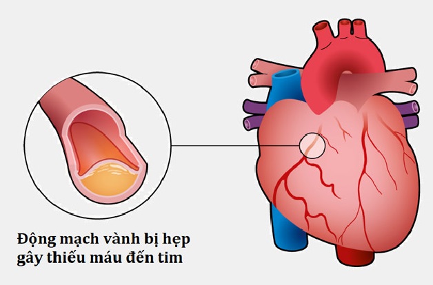 Xơ vữa động mạch vành là một trong những nguyên nhân phổ biến nhất gây thiếu máu cơ tim