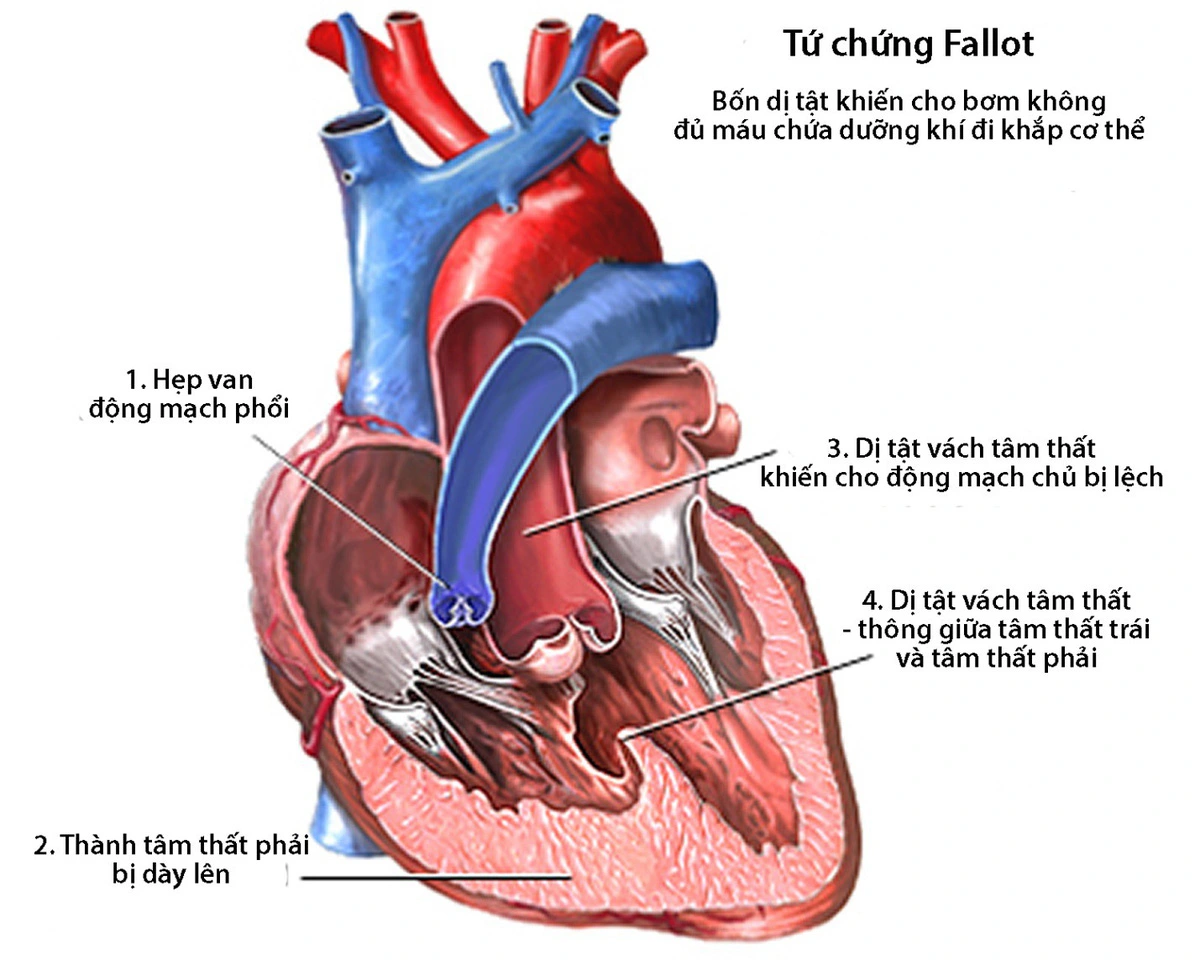 Tứ chứng Fallot