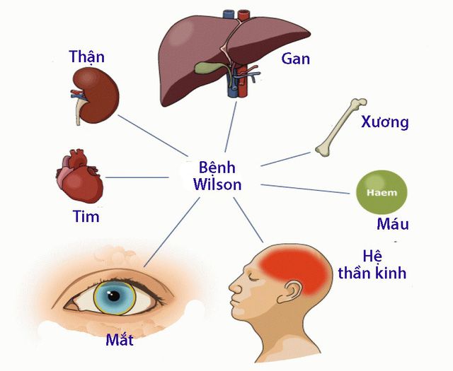 Minh hoạ về biểu hiện thần kinh ở người mắc bệnh wilson
