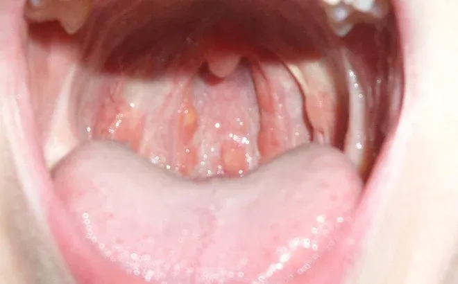 Minh hoạ về nấm Candida