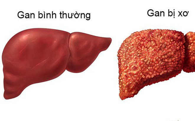 Viêm phúc mạc nhiễm khuẩn nguyên phát là biến chứng nguy hiểm của bệnh lý xơ gan
