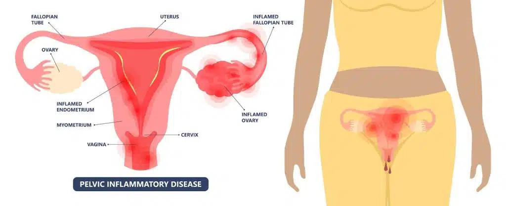 Viêm vùng chậu có thể trở thành viêm nhiễm mãn tính nếu không điều trị kịp thời