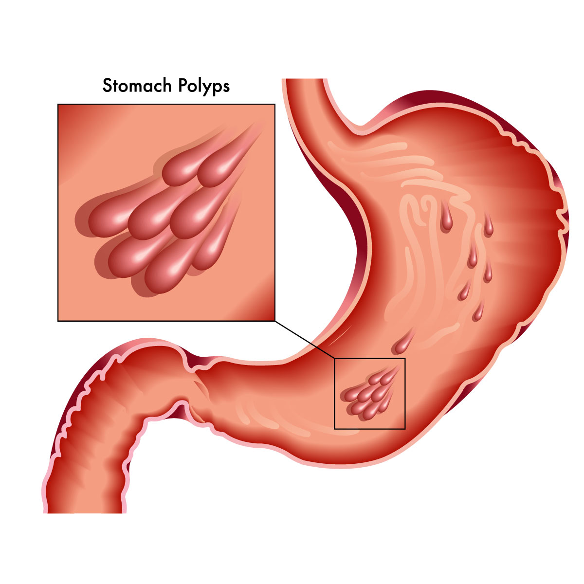 Polyp dạ dày có kích thước và hình dạng khác nhau