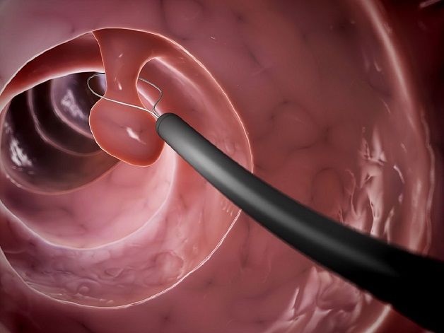 Hình ảnh minh họa khối polyp phát triển tại cổ tử cung