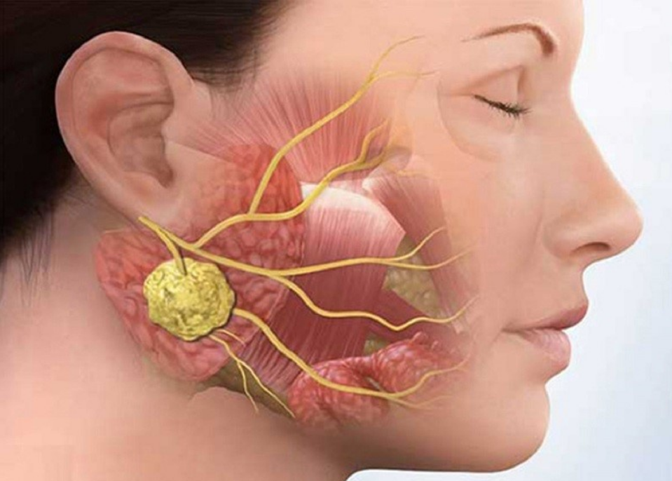 Viêm tuyến nước bọt