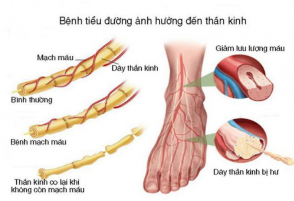 Bệnh lý thần kinh do đái tháo đường