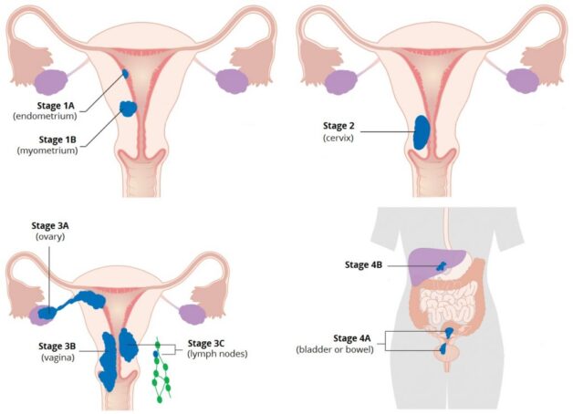 Tiến trình lan tràn của tế bào ác tính qua 4 giai đoạn ung thư buồng trứng 