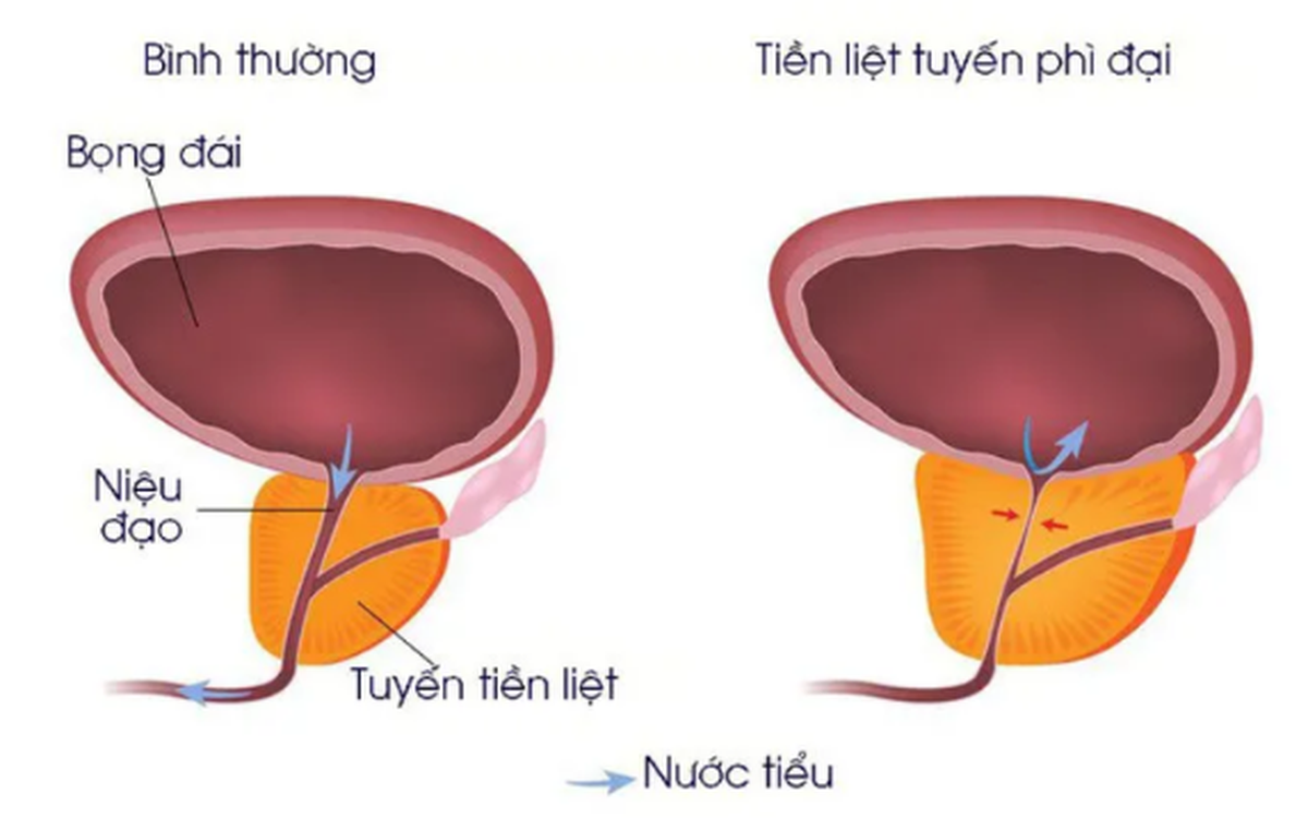 Phì đại tiền liệt tuyến là sự gia tăng kích thước của tuyến tiền liệt ở nam giới