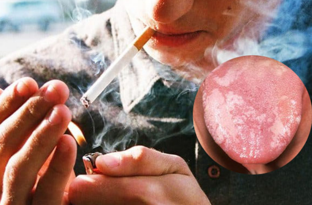 Hút thuốc lá làm tăng nguy cơ mắc bệnh bạch sản