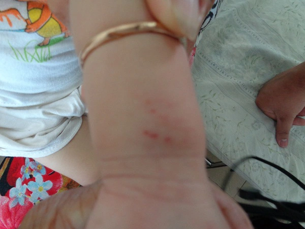 Sưng tấy đỏ và đau rát ở vùng da bị rắn cắn