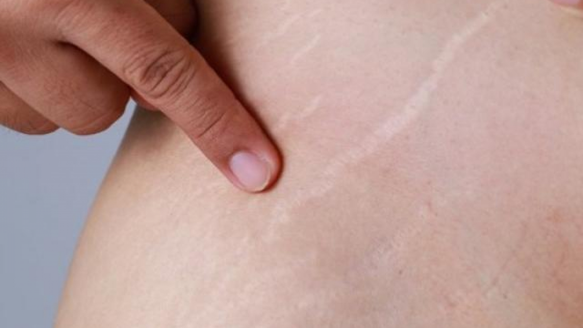 Bạn nên gặp các chuyên gia da liễu để điều trị rạn da