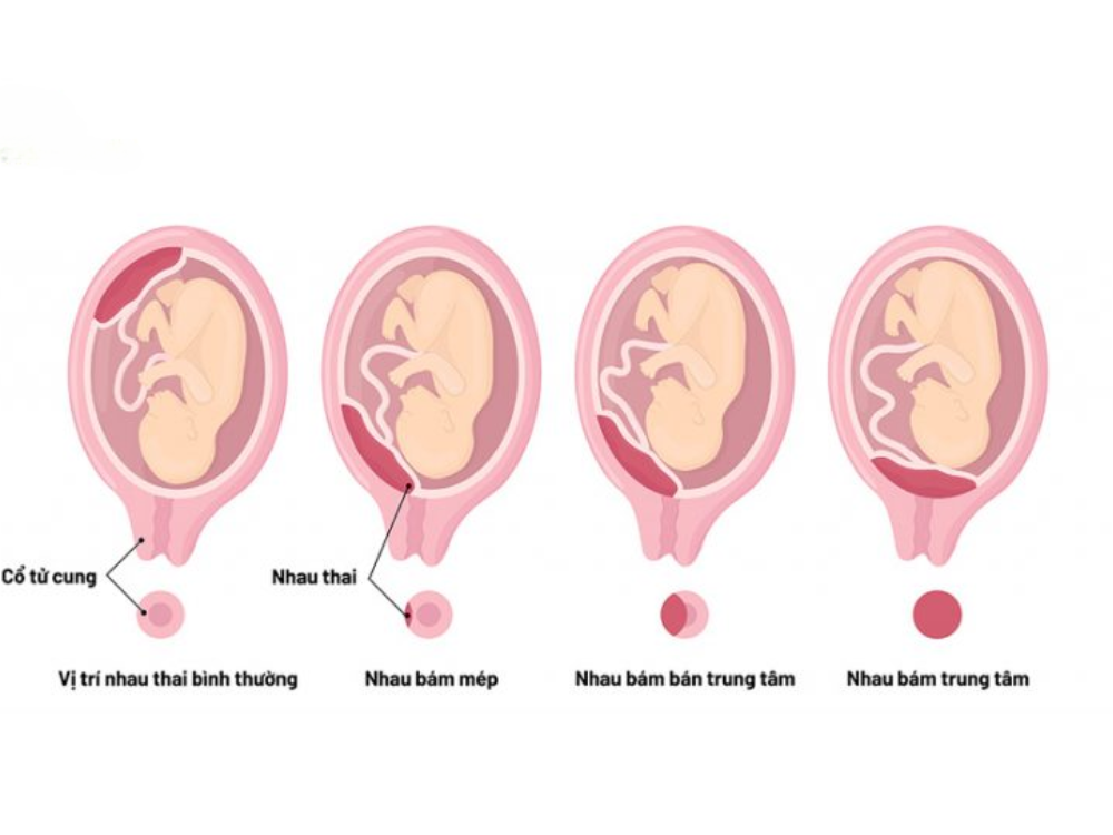 Nguyên nhân dẫn đến rau tiền đạo bám mép