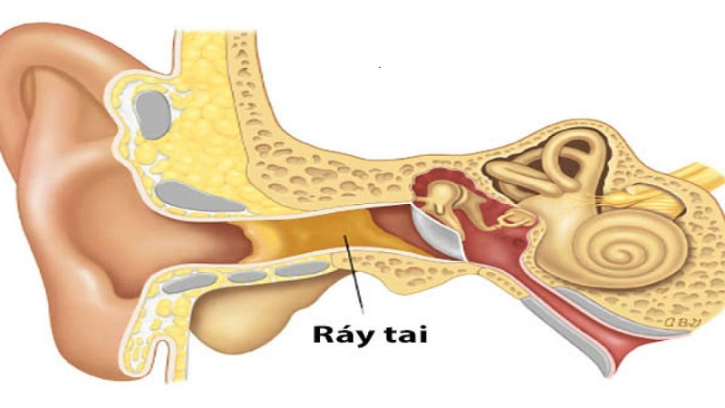 Hình ảnh vị trí của ráy tai trong ống tai