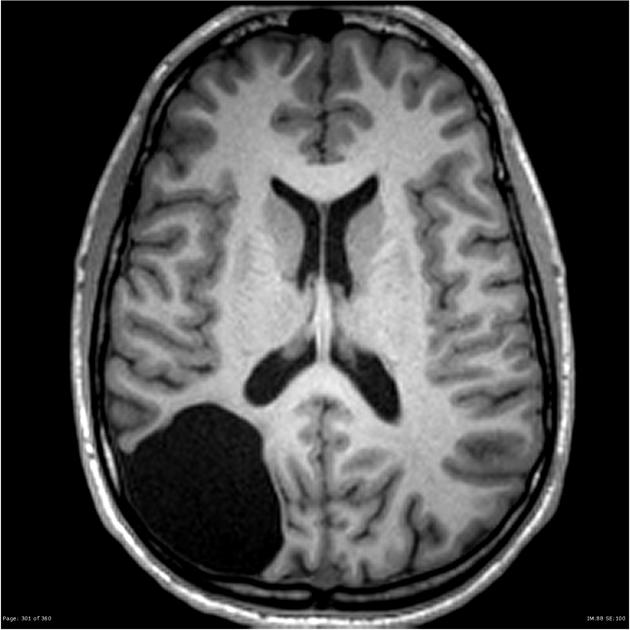 Để chẩn đoán rỗ não có thể sử dụng phương pháp chụp MRI