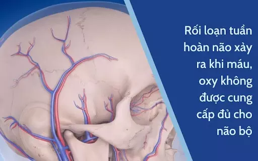 Rối loạn tuần hoàn não là gì?