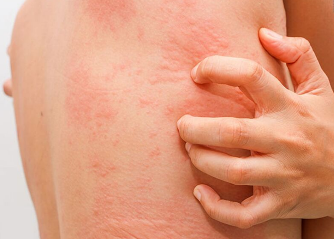 Dị ứng thức ăn dẫn đến các triệu chứng nổi mề đay, phát ban