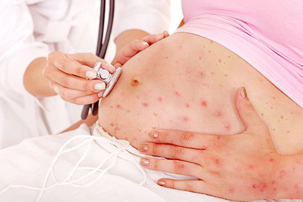 Rubella là bệnh nguy hiểm đối với bà bầu