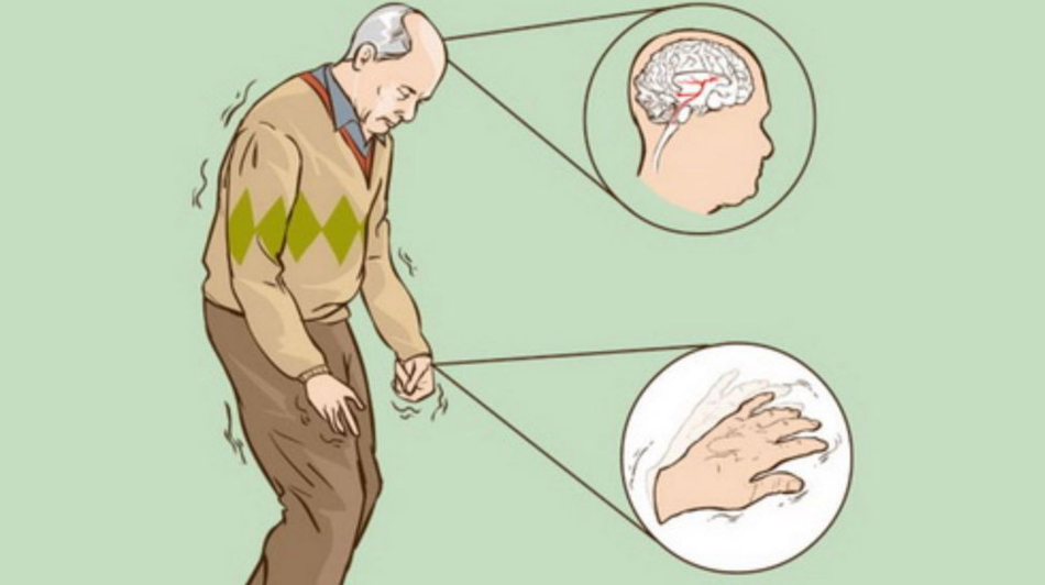 Bệnh Parkinson có thể là nguyên nhân gây ra tình trạng run