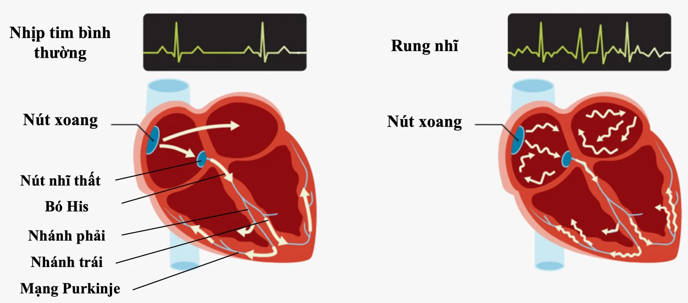 Nhịp tim không đều là triệu chứng phổ biến nhất của rung nhĩ