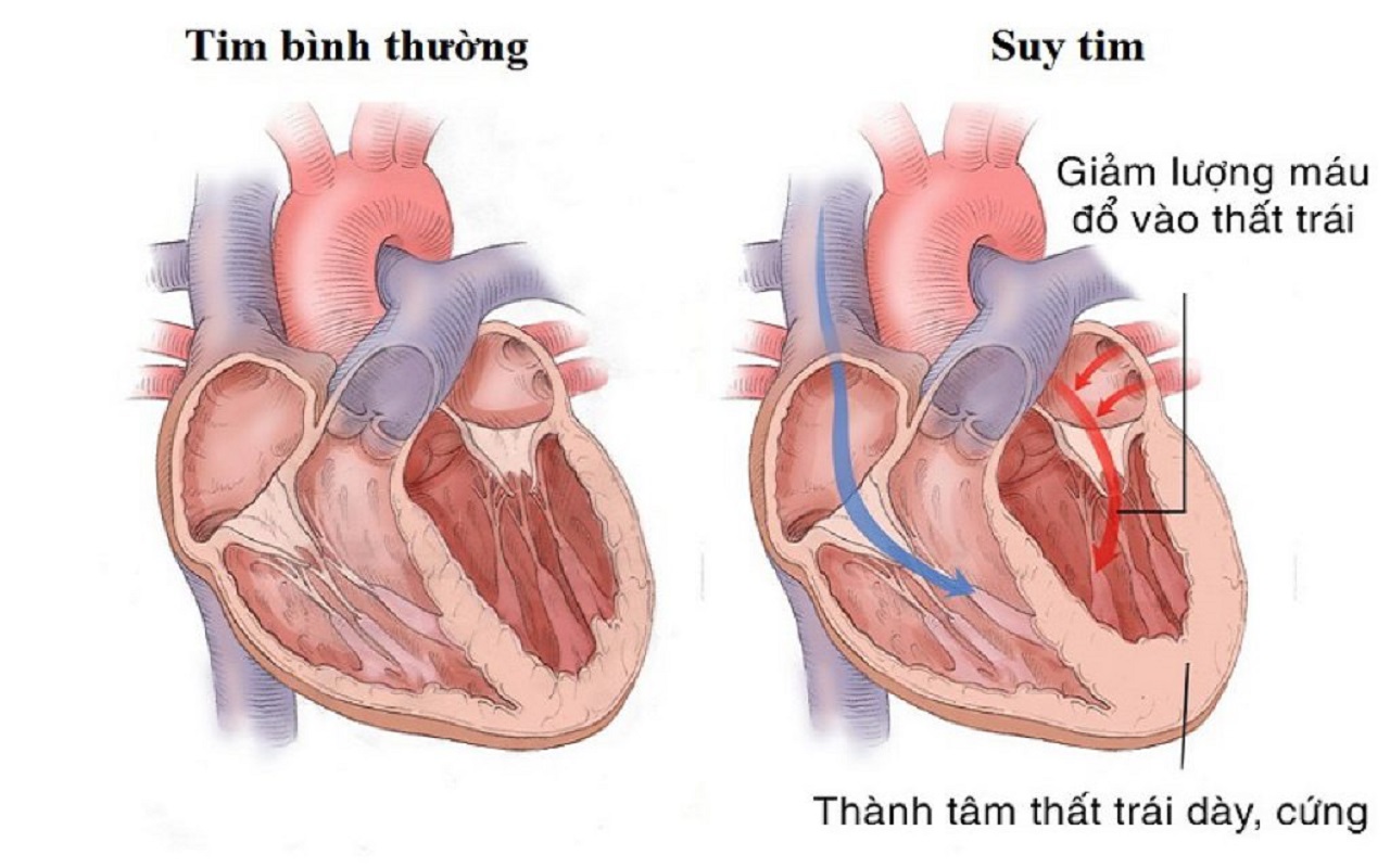 Tình trạng tim đập nhanh kéo dài và không được điều trị có thể dẫn đến suy tim