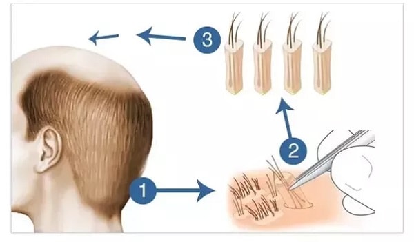 Phẫu thuật cấy tóc
