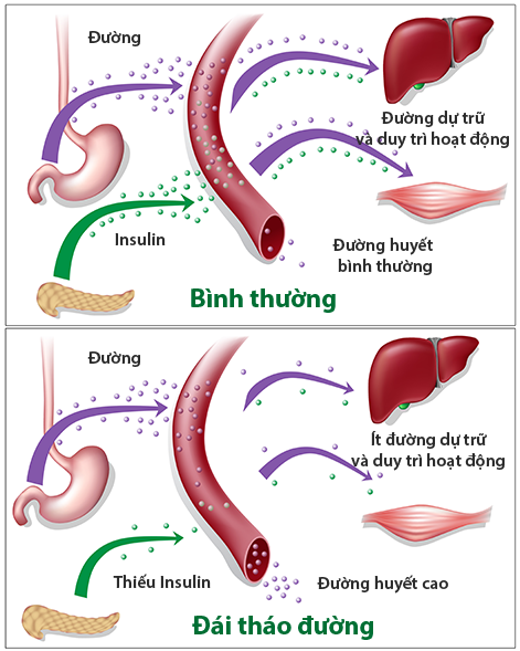 Tiểu đường hay còn gọi là Đái tháo đường