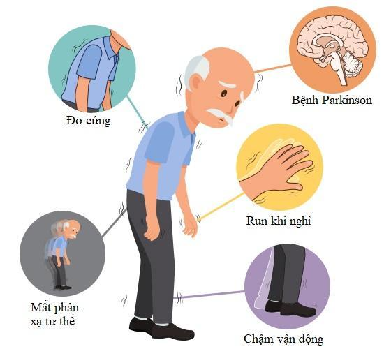 Bệnh Parkinson là một rối loạn thoái hóa thần kinh ảnh hưởng đến khả năng vận động của người bệnh.