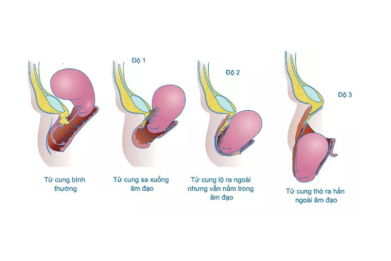 Các cấp độ sa tử cung