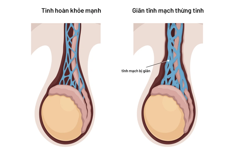 Sa tinh hoàn (Saggy Testicles) là tình trạng tinh hoàn bị xệ xuống do túi bìu bị giãn ra.