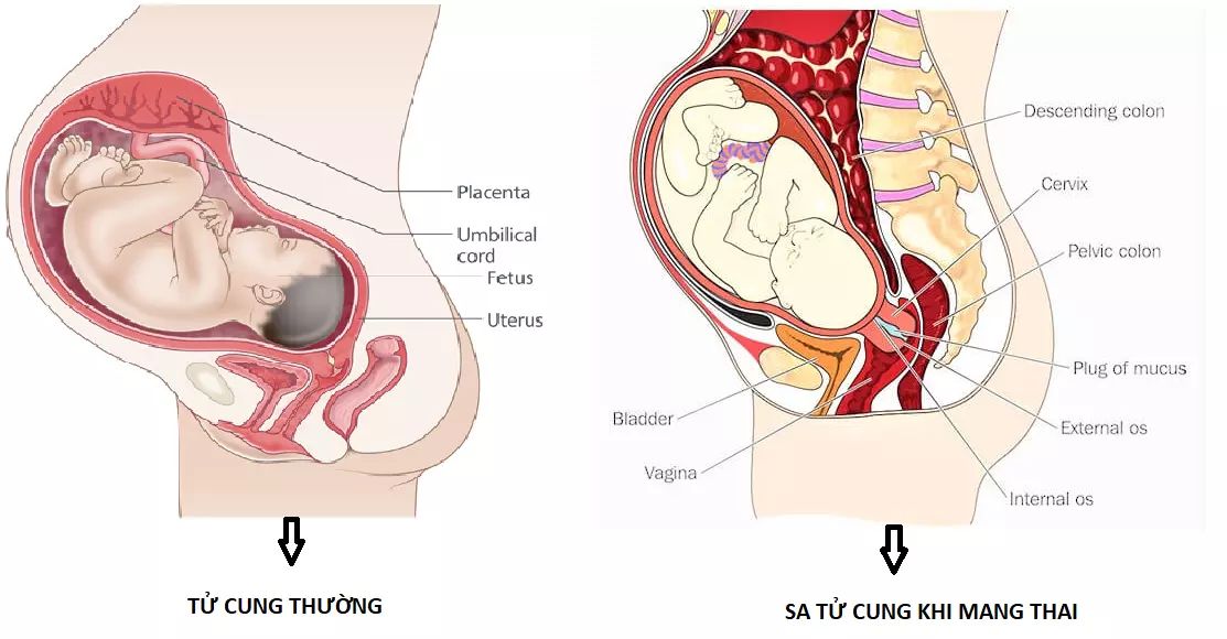 Sa tử cung khi mang thai