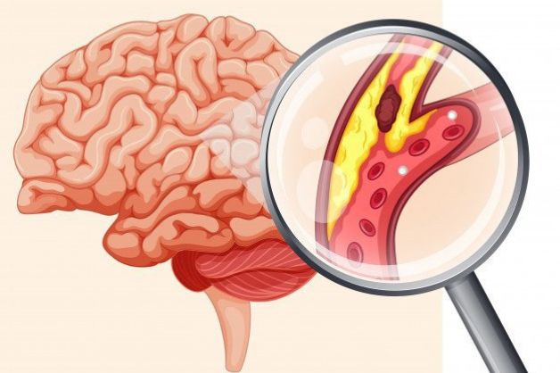 Nhồi máu não có thể gây hoại tử não, khiến người bệnh có nguy cơ tàn phế hoặc tử vong nếu không được cấp cứu kịp thời.