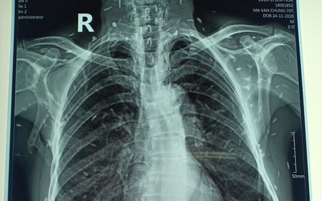 Top hơn 64 về hình lá phổi hay nhất - coedo.com.vn