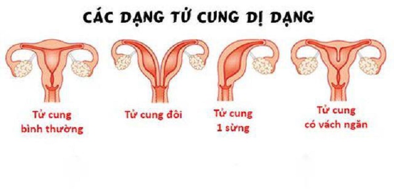 Tử cung dị dạng có thể gây khó khăn cho việc bám vào và phát triển của phôi thai