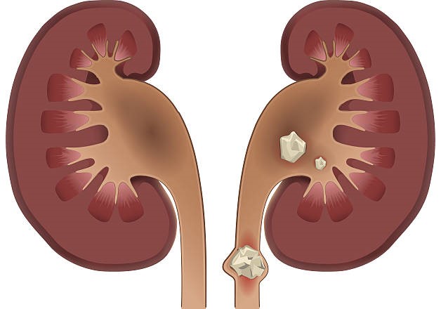 Bệnh sỏi thận là do sự lắng đọng của các tinh thể muối khoáng trong thận 