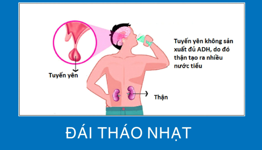 Chẩn đoán xác định đái tháo nhạt đòi hỏi sự kết hợp giữa các dấu hiệu lâm sàng và các nghiệm pháp sinh hóa chuyên biệt