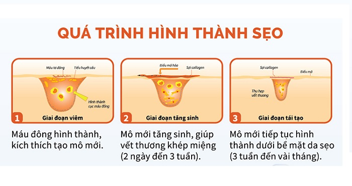 Quá trình hình thành sẹo