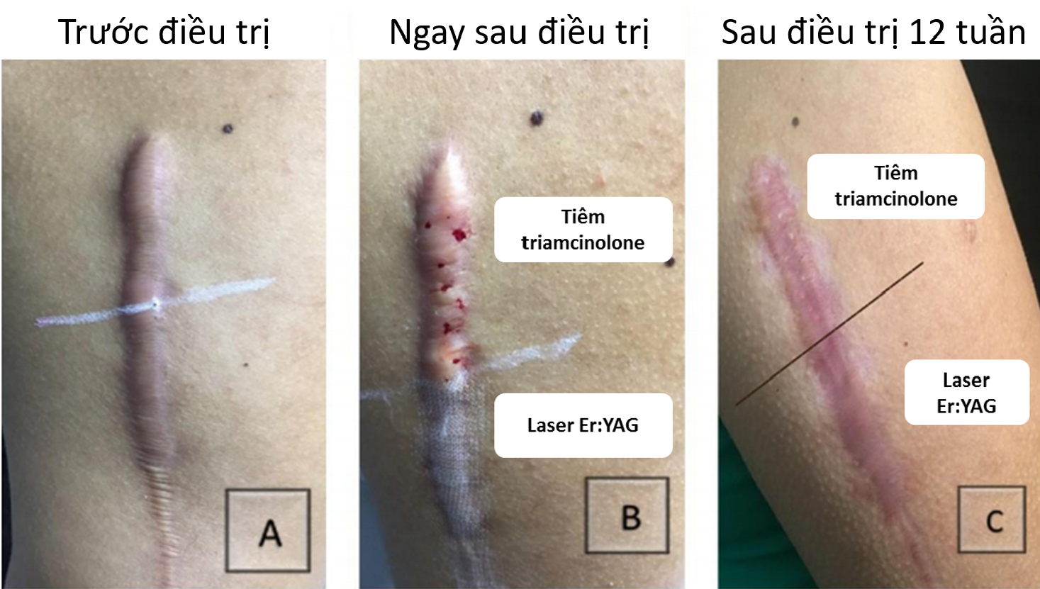 Sẹo lồi ở vùng cánh tay. (A) trước điều trị, (B) ngay sau điều trị, (C) sau điều trị 12 tuần.