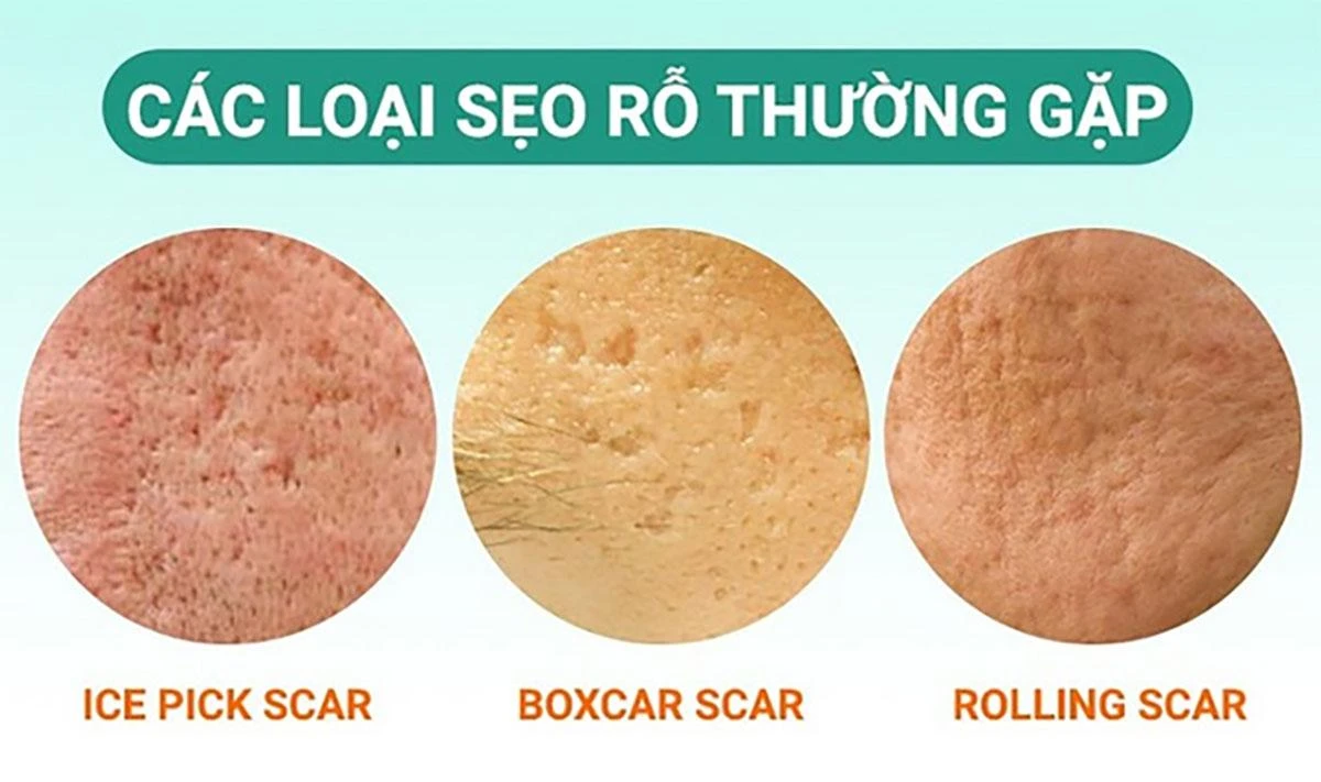 Phân loại sẹo rỗ 