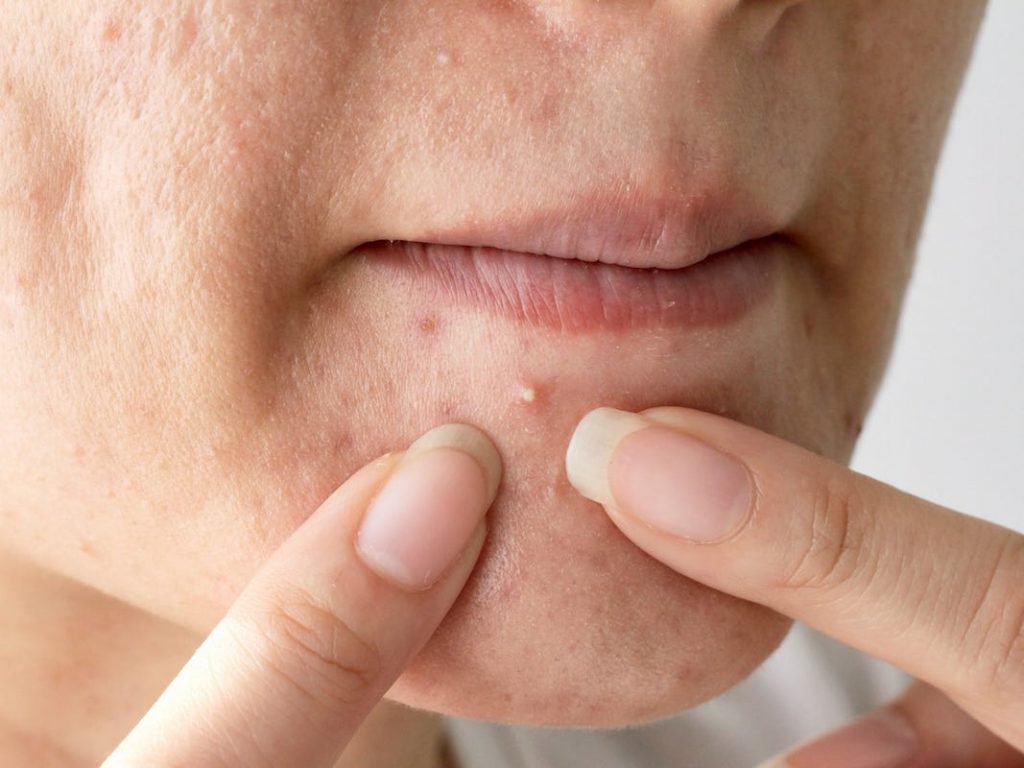 Cách chăm sóc da tuổi dậy thì bị mụn đầu trắng