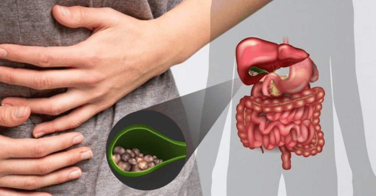 Tổng quan chung sỏi bùn túi mật