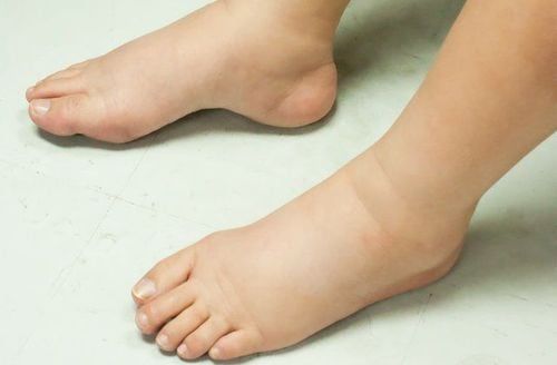 Khi xuất hiện phù tay chân kèm theo các dấu hiệu cảnh báo nguy hiểm, cần đưa người bệnh đi cấp cứu ngay lập tức.