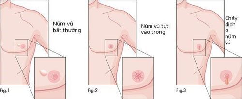 Dù các triệu chứng này không đặc hiệu, nhưng hãy cẩn trọng và thực hiện khám sức khỏe định kỳ nếu có dấu hiệu bất thường khiến bạn lo lắng. 