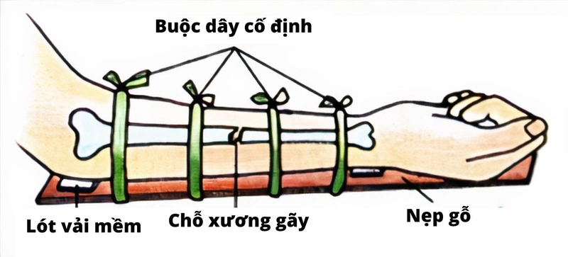 Sơ cứu gãy tay