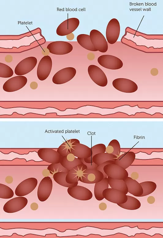 Xuất huyết giảm tiểu cầu (Immune Thrombocytopenic Purpura - ITP) là một bệnh lý số lượng tiểu cầu trong máu giảm sút