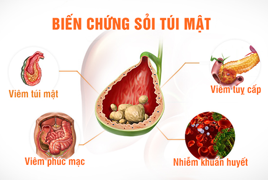 Biến chứng của bệnh sỏi mật