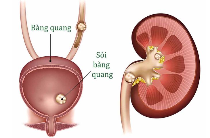 sỏi bàng quang