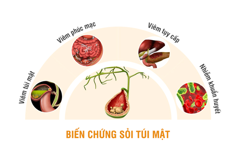 Các biến chứng của bệnh sỏi mật