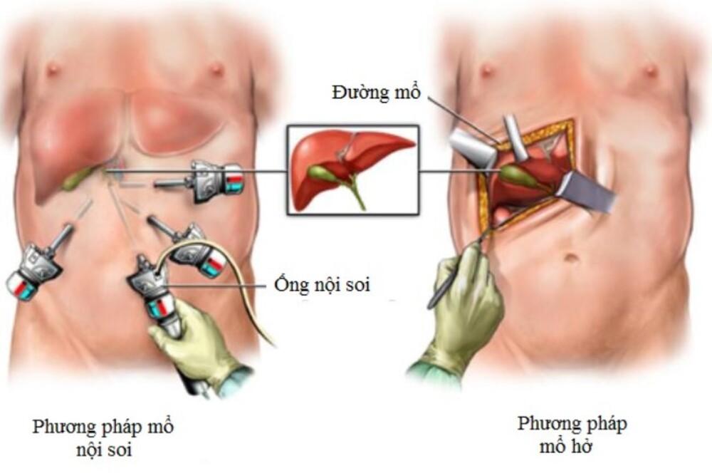 Phương pháp điều trị sỏi mật