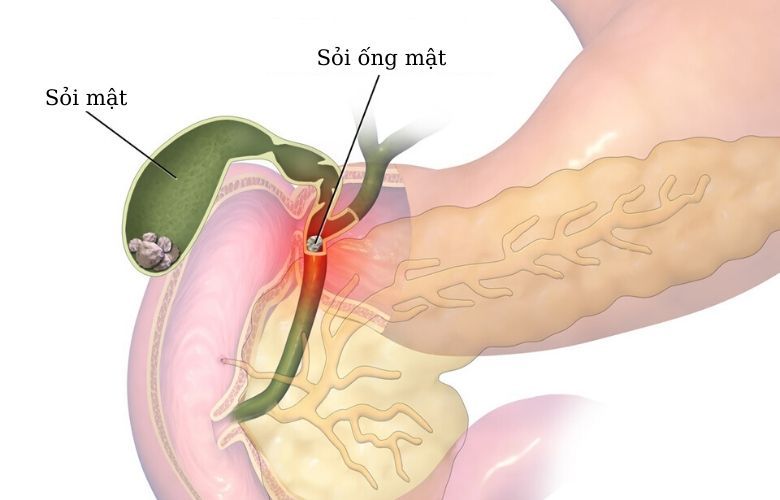  Sỏi mật và sỏi ống mật là những nguyên nhân phổ biến gây tắc nghẽn đường dẫn mật, dẫn đến tình trạng tăng Bilirubin trực tiếp trong máu. 